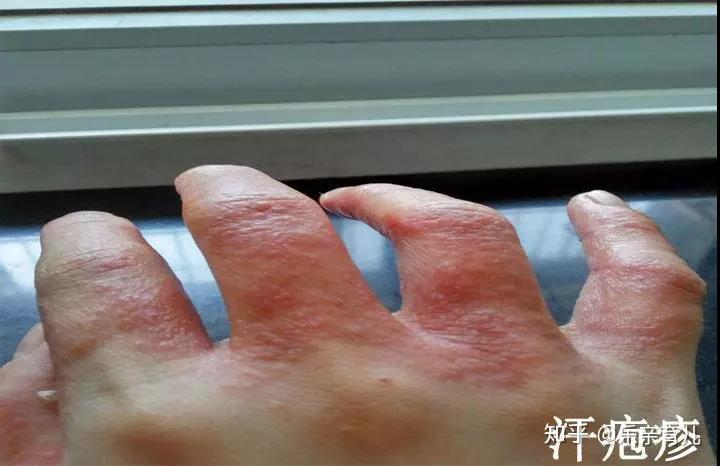汗疱疹了解一下