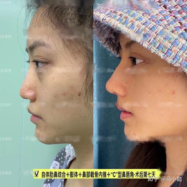 隆鼻审美微驼峰鼻最全功课全国擅长驼峰鼻的隆鼻医生盘点附案例