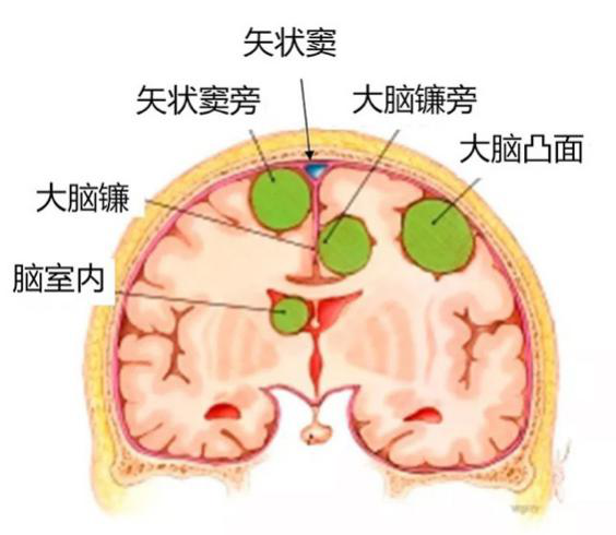 脑膜瘤如何手术不同位置脑膜瘤的手术方案分析