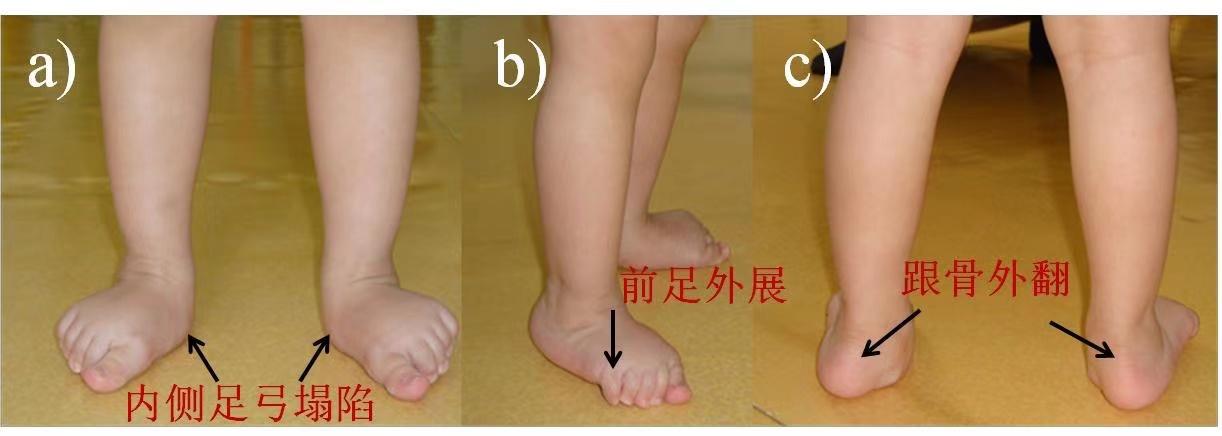 女童只因早学步两个月,却花几年时间治疗足外翻——早