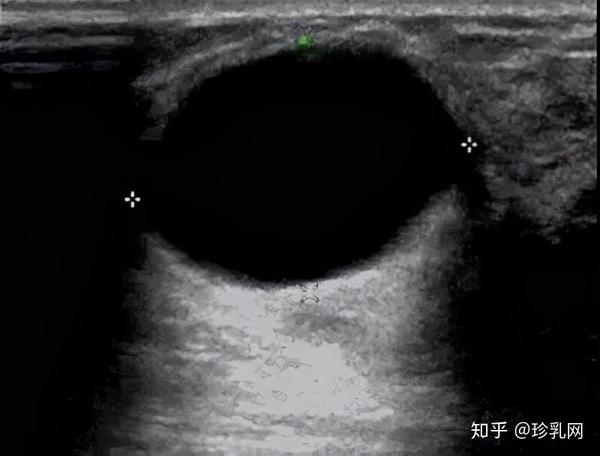 乳腺囊肿什么鬼?专家解答来了