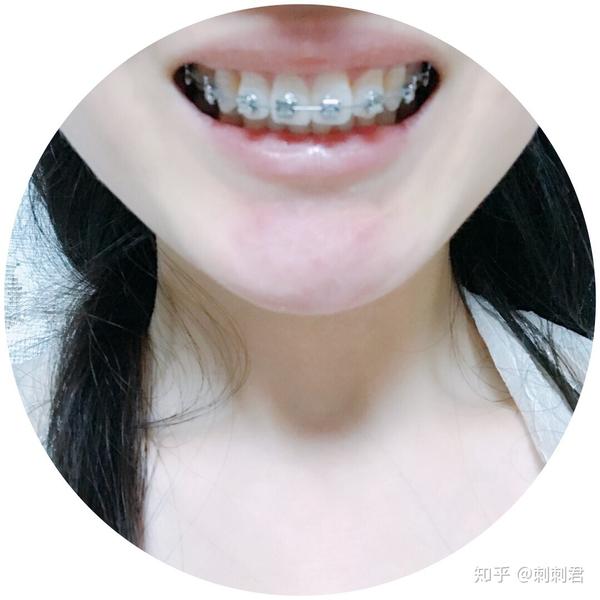 五个月后戴上了下牙的牙套网上套利技巧图片