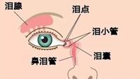 出生仅九天的急性泪囊炎小朋友经泪道探通成功治愈