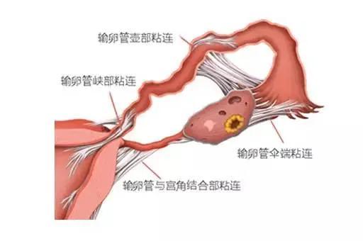 【警惕】小毛病引出大问题,盆腔粘连该如何好孕!