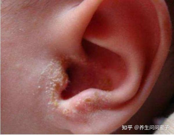 6岁男孩耳朵潮湿发痒,医院一查长了真菌,可能流脓失聪