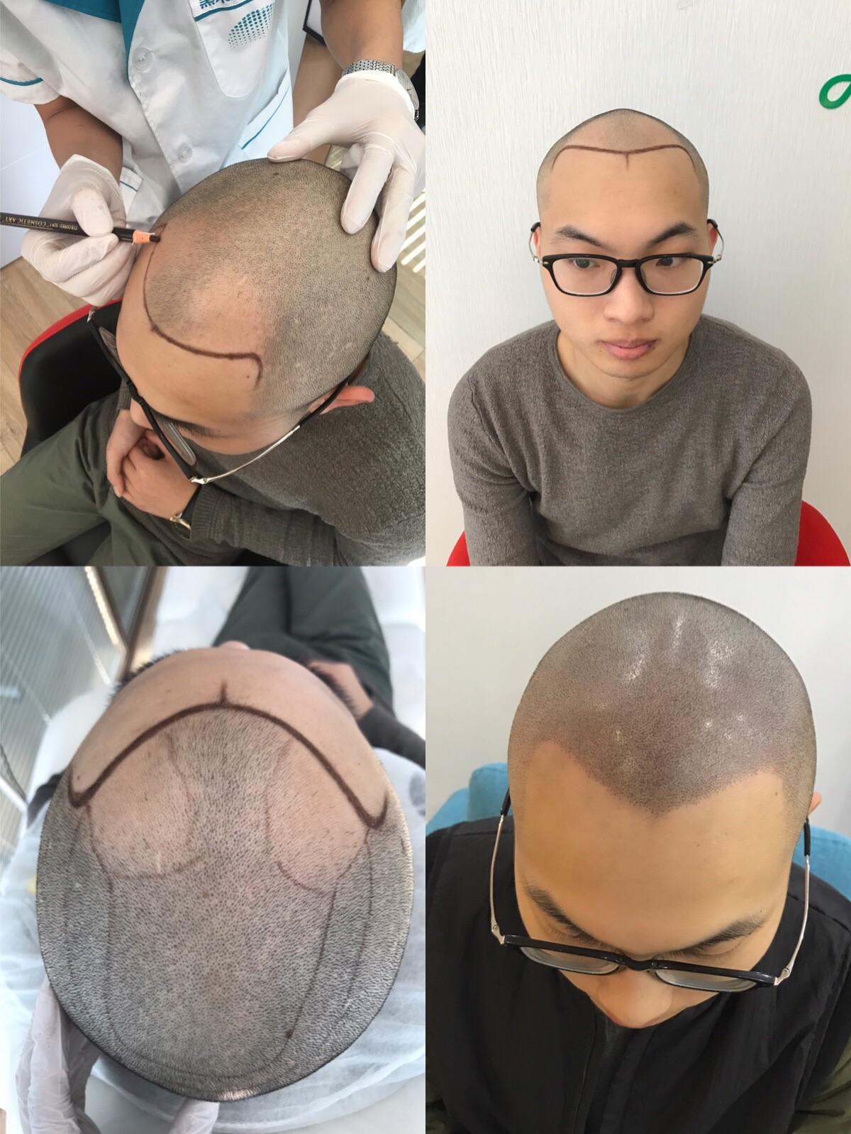 纹发,专业术语为smp(scalp micro pigmentation)