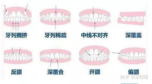 为什么牙齿矫正的价格相差好几万?