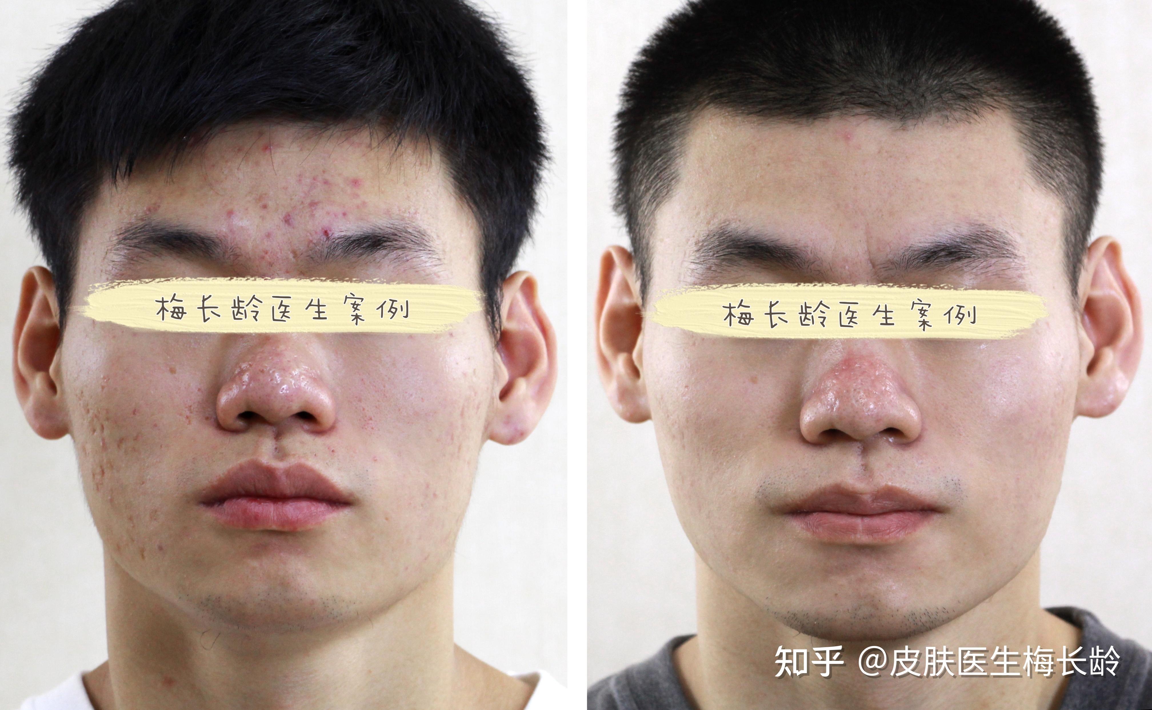 点阵激光去痘坑的效果如何