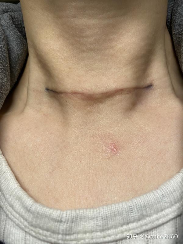 甲状腺切除手术疤痕恢复记录
