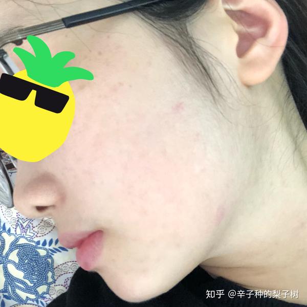 脸上长了很多又红又痒逆光疹子有些透明的尖头看起来油油的脂溢性皮炎