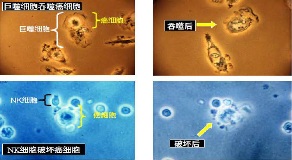 bak免疫细胞疗法----消灭体内潜在癌细胞有效提升免疫