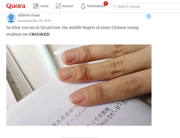中国学生的中指,因为长期握笔而出现轻微变形和老茧