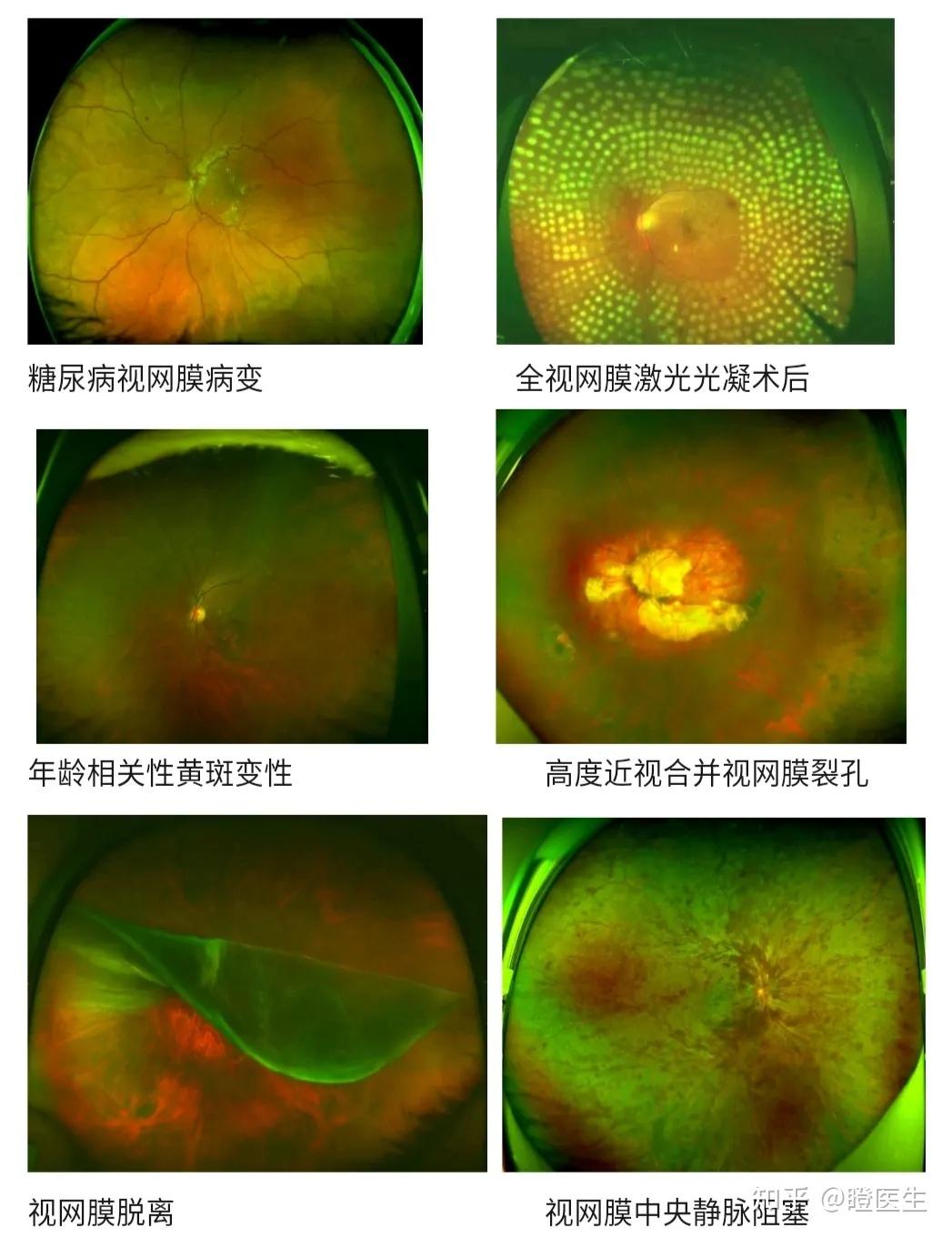 眼底检查中的神器到底神在哪