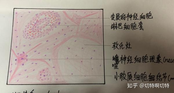 5.急性肾小球肾炎 中性粒细胞浸润