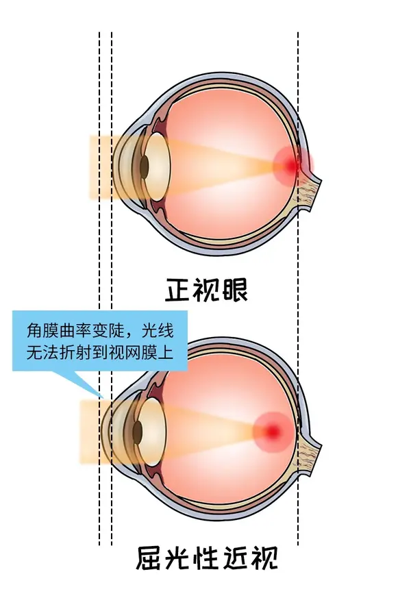不同的年龄段,眼轴和角膜屈光度的正常范围也有所不同