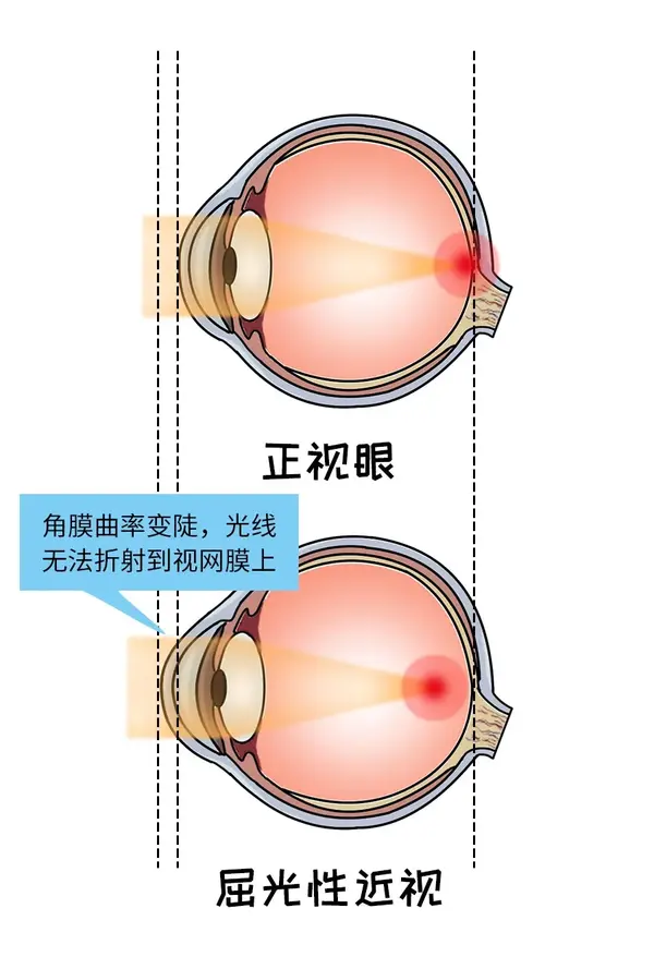 这主要是由于角膜或晶状体曲率过大或各屈光成分之间组合异常,屈光力