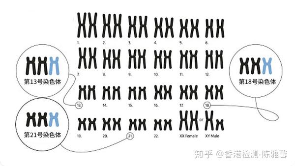 唐氏综合征又称「21三体综合征」,是一种由染色体数目异常导致的遗传