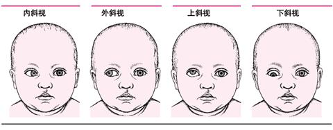 现在斜度小,那么孩子视物时歪头现象可能与眼睛的斜视是有关系的