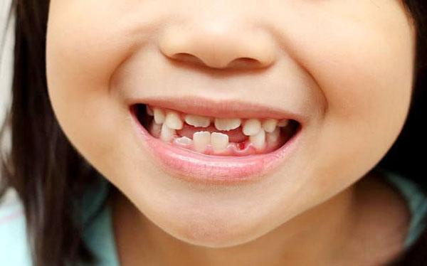 如何预防和治疗孩子牙齿不齐