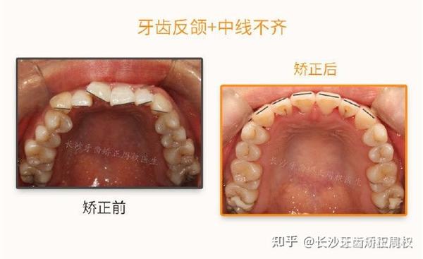 长沙牙齿矫正: 地包天 中线不齐>正畸案例