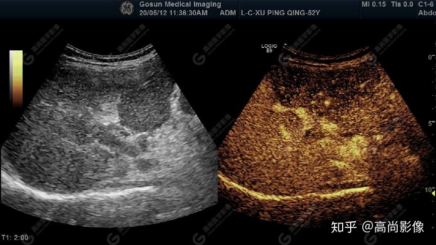 其内部无明显血流超声提示肝硬化声像图表现门静脉内实性占位病变