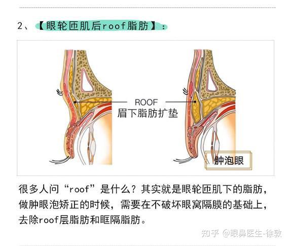 肿眼泡割双眼皮为什么要注意roof脂肪层