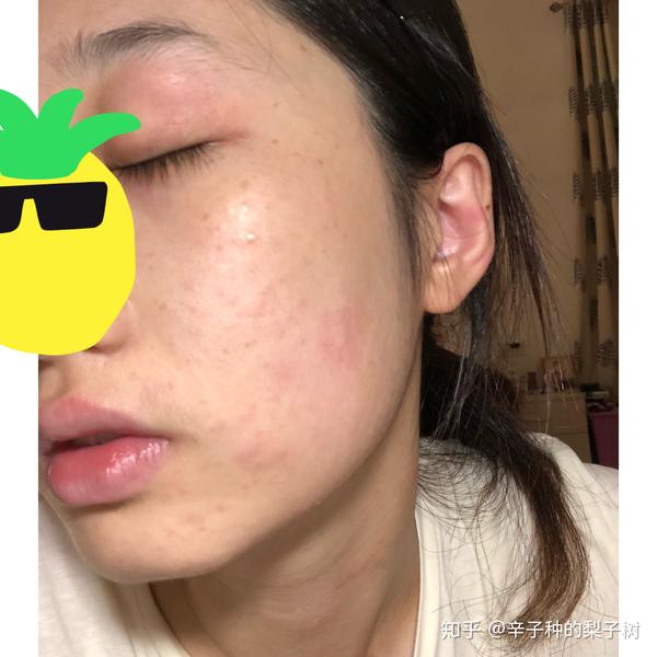 脸上长了很多又红又痒逆光疹子,有些透明的尖头看起来