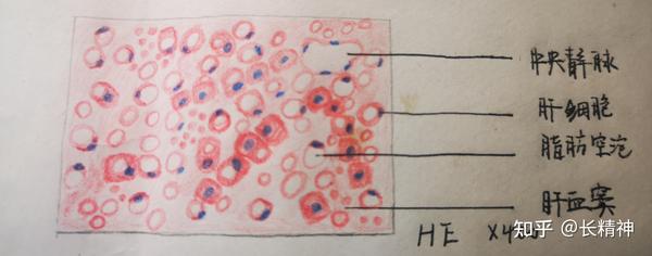 低倍镜观察:肝细胞呈弥漫性病变,小叶结构存在,肝细胞拥挤,肝窦狭窄
