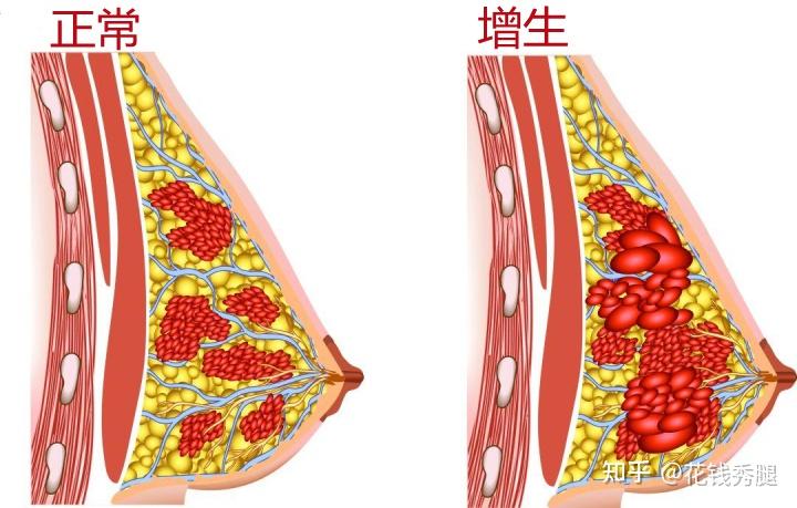 乳腺增生如何自检