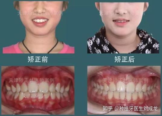 单纯正畸治疗矫正成人骨性龅牙,求推荐郑州矫正医生?