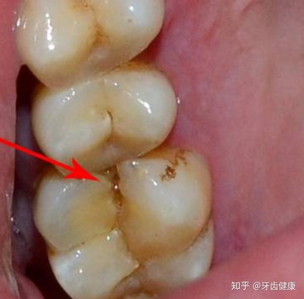 牙齿裂了一条缝,怎么办?是不是需要拔牙?