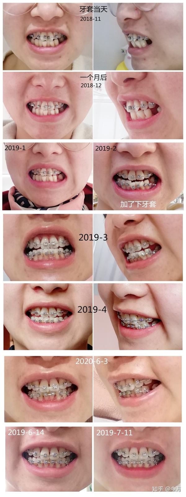 24岁牙齿矫正过程照片对比77经验分享