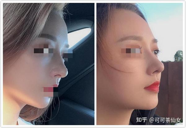 成都隆鼻有哪些做自然风性价比高的医生?