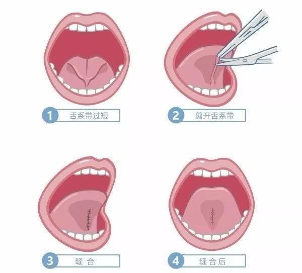 孩子舌系带短真的需要手术吗(建议收藏)