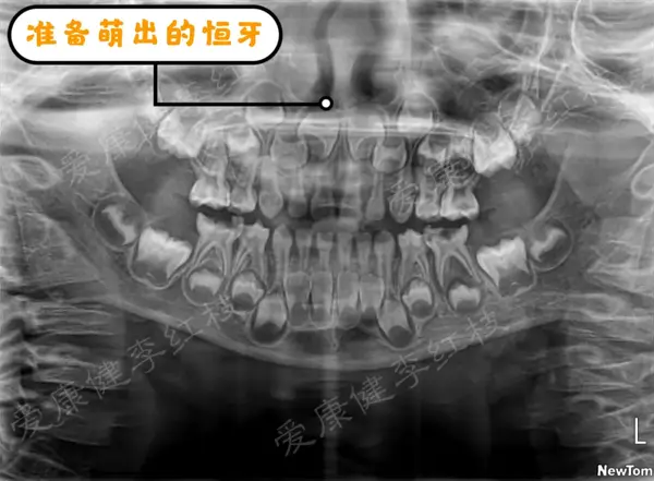 口腔科医生会针对儿童缺牙情况,通过拍摄x光片,了解恒牙胚的发育情况