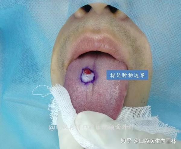 舌头上长疙瘩,超高频电刀轻松切除舌背肿物!