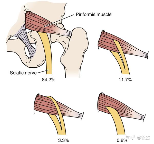 约15%的人坐骨神经从梨状肌中穿过