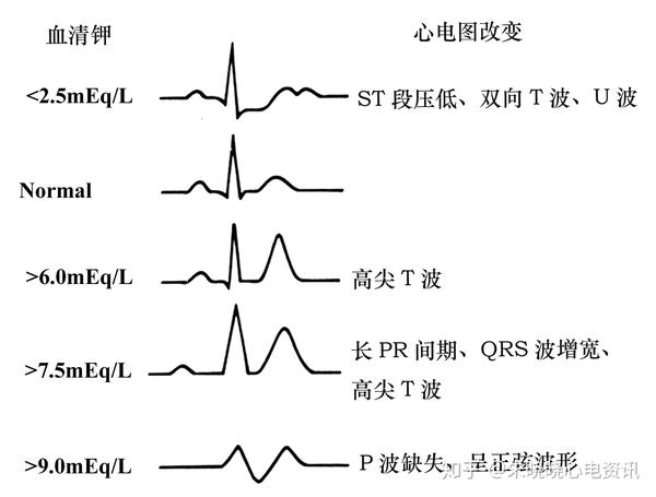 一洋地黄 1 st段呈鱼钩样下移:只提示洋地黄心肌作用已发生.