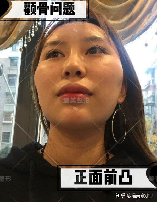 这种情况下,只需要施行颧弓内推手术,就可以达到到很好的效果.