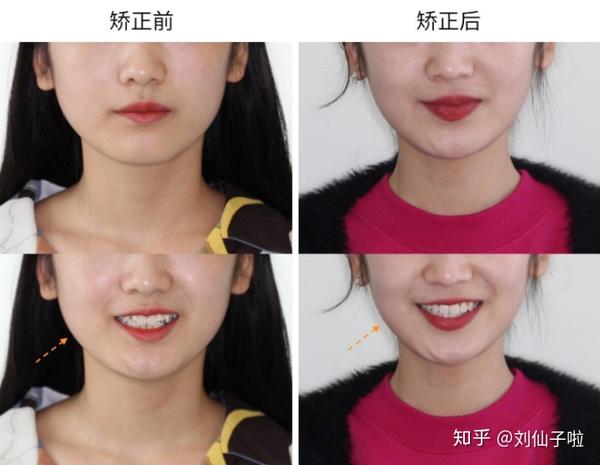 牙齿矫正正畸要花多少钱