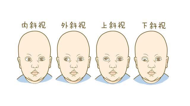 斜视能治好吗