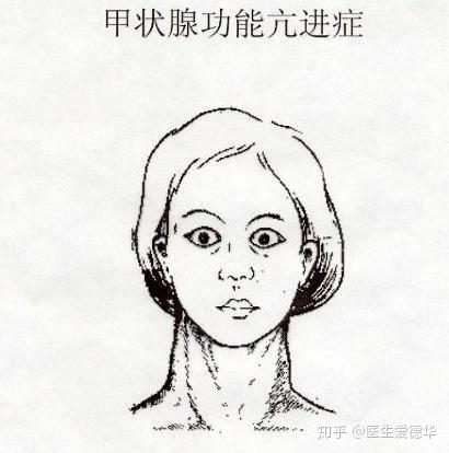 甲亢突眼,这可不是炯炯有神