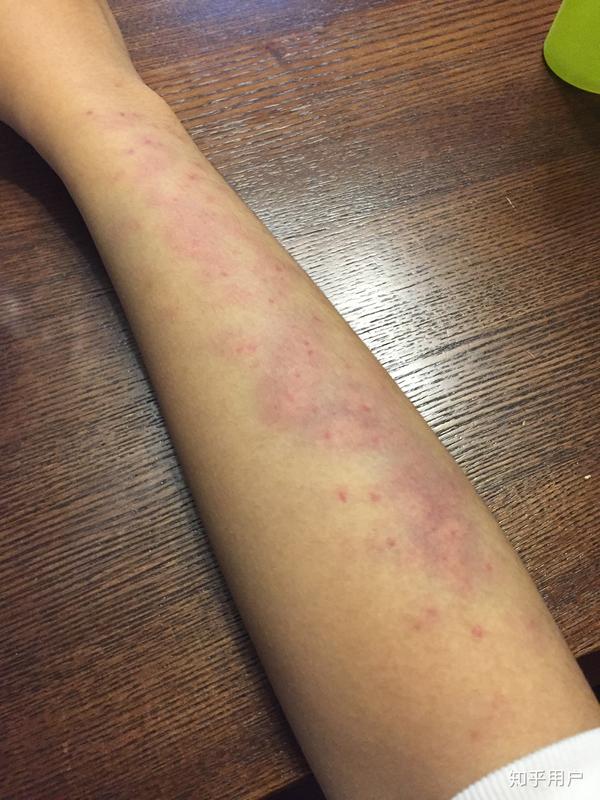 抑郁症焦虑症狂躁症到底有多煎熬?