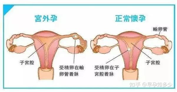 宫外孕是怎么回事儿?