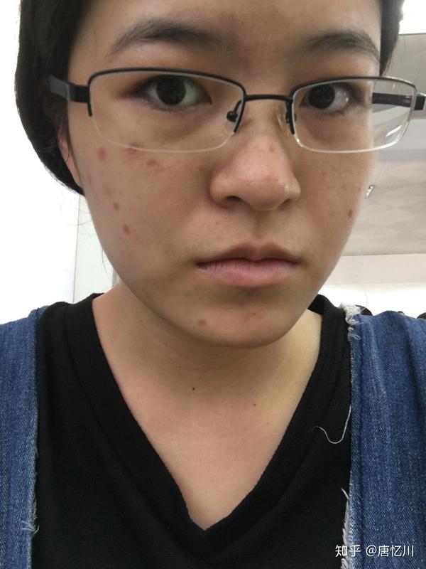 激光点痣(多图辣眼)