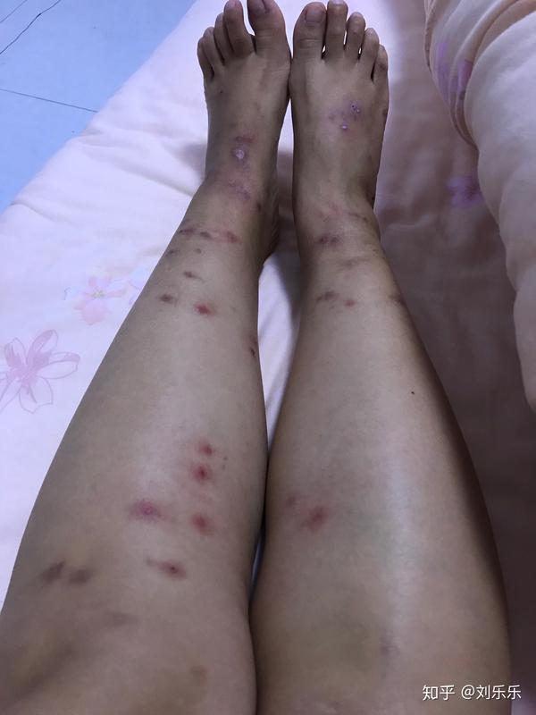 被跳蚤咬过的腿.