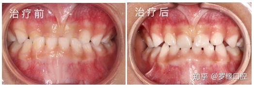 宝宝牙齿矫正的3个黄金期,别错过!