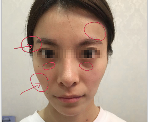 颧骨高,两颊凹陷,腮骨突出很难看,请问怎么使面部增肥