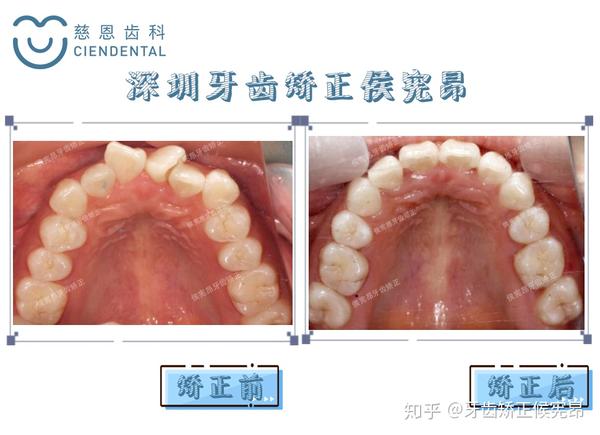 前牙扭转,牙齿拥挤