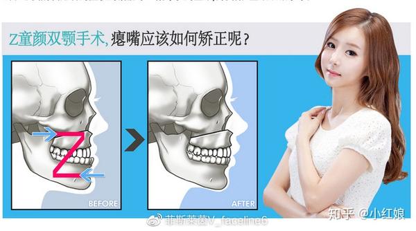 术后上颚和下颚的位置不仅可以正常交换而且还可以改变成童颜.